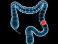 caancer de_colon
